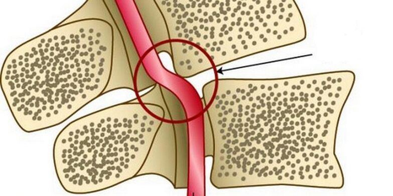 Deformazione dell'arteria vertebrale dovuta a instabilità vertebrale